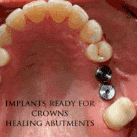 Dental Implants Slideshow